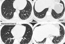 2021 10 14 23 03 8719 2021 10 18 Ct Interstitial Lung Figure6 400