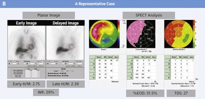 A representative case: an 83-year-old female patient had high total defect score and high percent extent of dysinnervation (% EOD) despite high late heart-to-mediastinum ratio (H/M) of ≥ 1.9. She experienced emergent heart failure hospitalization 11 months after discharge. Image courtesy of JACC: Cardiovascular Imaging.