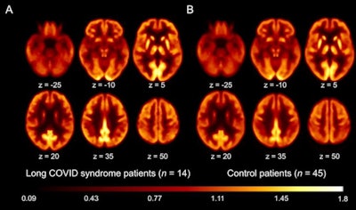 Transaxial sections F-18 FDG PET scans in patients with long COVID-19 (A) and control patients (B). Image courtesy of the Journal of Nuclear Medicine.