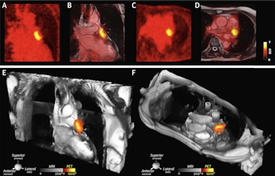 A large thrombus is seen in the left atrial appendage (LAA) behind the device on (A and B) the coronal PET and PET/cardiac MRI images as well as (C and D) the axial PET and PET/cardiac MRI images. (E and F) 2D balanced steady state free precession cines stacks in the coronal and axial planes have been combined into a single 3D dataset and fused with the 3D PET data. In these multimodality images, the PET and MR data are both displayed in 3D, creating a volumetric depiction of the heart and the thrombus/Cu-64 FBP8 containing LAA. Volume-rendered images in the oblique coronal and axial planes confirm the presence of thrombus in the LAA. (A to F) The thrombus produced by the closure device is contained within the LAA, and no evidence of thrombus is seen elsewhere in the heart or thorax. Image courtesy of JACC: Cardiovascular Imaging.