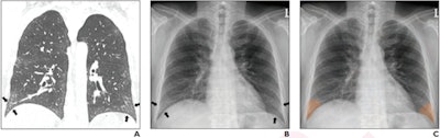 (A) Coronal chest CT shows bilateral lower lobe pleural-based mild reticular opacities with traction bronchiectasis (arrows). (B) Chest radiograph shows subtle corresponding subpleural opacities in basal lung zone bilaterally (arrows). Only one of six readers detected reticular opacity when interpreting radiograph alone. (C) Abnormalities annotated on deep-learning algorithm in basal lung bilaterally with probability of 0.99. Algorithm deemed true-positive for reticular opacity. Five of six readers detected reticular opacity using the algorithm. Image and caption courtesy of the American Journal of Roentgenology.
