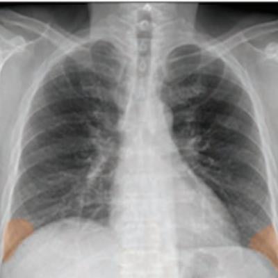 interstitial pneumonia x ray
