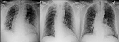 An example of a patient with a chest x-ray score of 6 at admission and scores of 4 before discharge and at three months follow-up. Image courtesy of Radiology.
