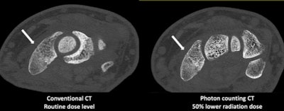 Conventional and photon-counting CT scans of the same patient demonstrate improved visualization of trabeculae and a wrist fracture while using 50% less radiation. Images courtesy of the Mayo Clinic.