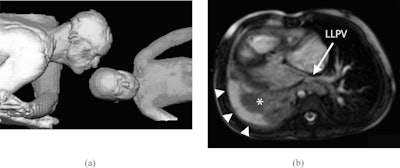 (A) Volume-rendering reconstruction of father and daughter in MRI scanner bore. (B) Axial image from a steady-state free precession acquisition. LLPV = left lower pulmonary vein.