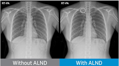 Chest radiograph without Auto Lung Nodule Detection (ALND) and chest radiograph with lung nodule marked. Image courtesy of Neuologica.