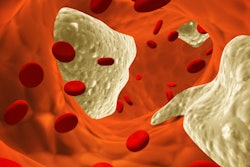 2017 09 25 22 48 3199 Atherosclerosis Clot 400