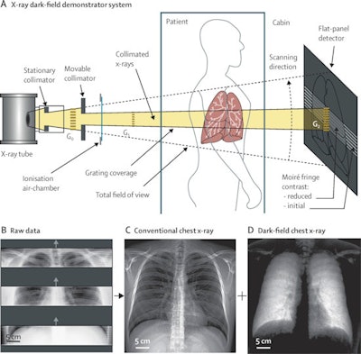 Schematic of the x-ray dark-field demonstrator system (A) and examples of raw detector imaging data (B), retrieved conventional chest x-rays (C), and dark-field chest x-rays (D) from the first in-human application.