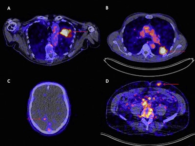 Zr-89 pembrolizumab-PET/CT image examples at day 7 of tumor lesions in various patients. Red arrows indicate tumor lesions. Images A and B are scaled 0-8 SUV, images C and D are scaled 0-5 SUV. A) Tumor lesion left upper lobe, NSCLC. B) Pulmonary metastasis, melanoma. C) Brain metastasis, melanoma (SUVmax 4.20). D) Abdominal wall metastasis, melanoma (SUVmax 5.02).