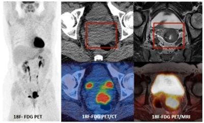PET/MRI provides a one stop examination for staging cervical cancer due to the superior contrast resolution of MRI compared to CT. All images courtesy of Dr. Vicky Goh, presented at the BIR Annual Congress.