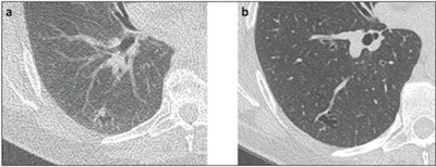 58-year-old woman with right lower lobe nodule. (a) Present lung cancer screening CT and (b) lung cancer screening CT performed 2 years prior. Nodule described as growing pure ground-glass nodule (associated with cystic lesion), measuring 15 mm in mean diameter. Nodule categorized Lung-RADS 3 by clinical report, though Lung-RADS 2 by strict application of size criteria. Subsequent wedge resection demonstrated lepidic-predominant adenocarcinoma. Images and caption courtesy of the AJR.