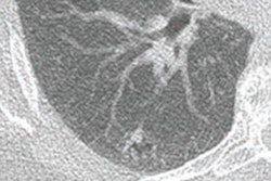 2021 11 12 23 02 3668 2021 11 15 Ajr Lung Cancer Ct 20211112234534