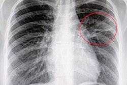 2021 11 17 17 39 6012 Lung Pneumonia Cad 400