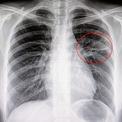 2021 11 17 17 39 6012 Lung Pneumonia Cad 400