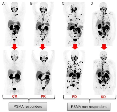 PSMA responders: patient (A) with the disappearance of all PSMA-positive lesions (complete response) and patient (B) with a decrease of PSMA-TV >30% (partial response). PSMA nonresponders: patient (C) with the appearance of new lesions and increased PSMA-TV >30% (progressive disease) and patient (D) with neither new PSMA-positive lesions nor PSMA-TV 30% changes (stable disease). Image courtesy of the Journal of Nuclear Medicine.
