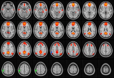 MRI images of the brain with the default mode network highlighted in orange/red. The default mode network is active during periods of wakeful rest, when the mind is not focused on a particular task. The green and blue arrows point to areas of the network that are disrupted in adolescent patients with concussions. Image and caption courtesy of the RSNA.