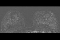 2021 11 19 23 54 6612 2021 11 22 Huck Breast Mri Iu Ds 400