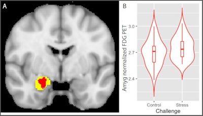 Psychological stress increases amygdala metabolism: Glucose metabolism in the insula is significantly greater during stress relative to control condition. A) Voxels showing a significant main effect of stress (stress > control; red) in a small-volume corrected analysis of a Harvard-Oxford amygdala defined region of interest (yellow; image thresholded at corrected p < 0.05). B) Distribution of mean values of normalized amygdala glucose metabolism in voxels (red) showing a significant main effect of challenge during stress and control conditions. Image courtesy of Biological Psychology.