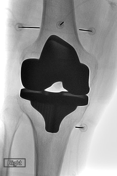 After introducer needle is put into position, the radiofrequency ablation electrode is placed into the introducer needle. Positioning was verified with imaging. All images and caption courtesy of Dr. Felix Gonzalez and the RSNA.