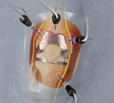 Cooled radiofrequency ablation technique.