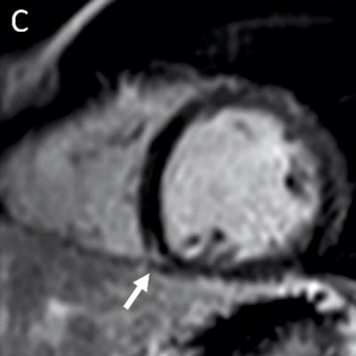 MRI shows late gadolinium enhancement at the right ventricular attachment of a 19-year-old male. Note: this image is for illustrative purposes and is not associated with the study. Image courtesy of Radiology