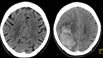 The left image shows the initial brain CT scan in a patient on both clopidogrel (Plavix) and aspirin who presented to the emergency department with head trauma with no intracranial hemorrhage. The right image shows a head CT obtained 24 hours later demonstrating a large parenchymal hemorrhage in the right frontal/parietal region. The patient died shortly after the second examination. Image and caption courtesy of Dr. Warren Chang and the RSNA.
