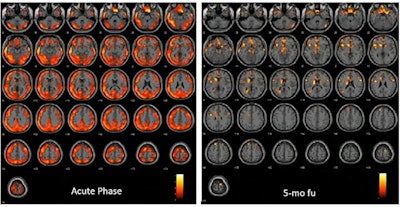 In one patient, FDG-PET during the acute phase showed an extended and severe hypometabolism affecting almost all brain cortices and some subcortical regions (caudates and L-thalamus). At five-month follow-up, only some spots of hypometabolism are present in the superior and middle frontal cortex, superior medial frontal cortex, and L-caudate nucleus. Image courtesy of Anna Lisa Martini.