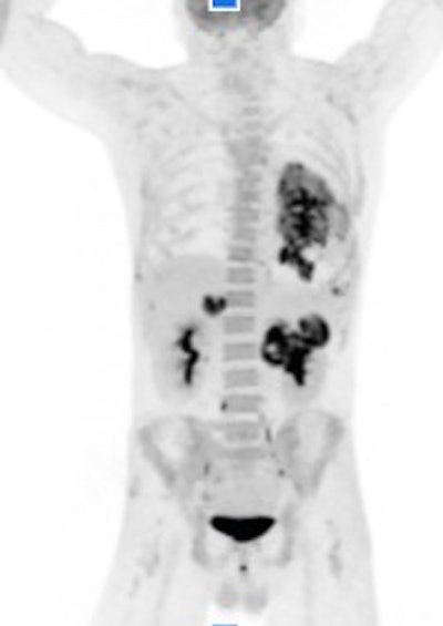 A PET/CT image acquired in 2.5 minutes with Canon's Cartesion Prime PET/CT scanner with deep-learning reconstruction applied. Image courtesy of Canon.