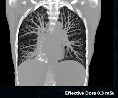 A CT lung cancer screening image acquired with Canon's SilverBeam technology at a radiation dose of 0.3 mSv. Image courtesy of Canon.