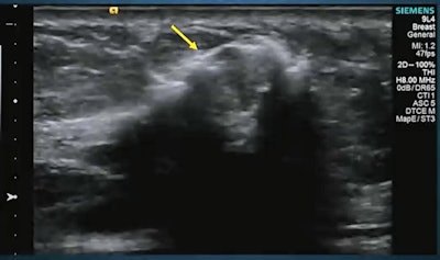 Sentinel lymph nodes can be identified through contrast-enhanced ultrasound lymphosonography (pictured), rivaling that of blue dye and radioactive tracers, according to research presented at the RSNA annual meeting. Image courtesy of Dr. Priscilla Machado.
