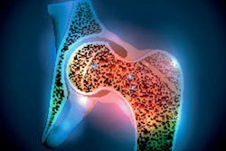 2021 04 06 21 52 3854 Osteoporosis Hip Joint 400