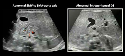 Midgut malrotation (above) and volvulus (below) can be found in pediatric patients with abdominal abnormalities. Ultrasound shows high sensitivity and specificity in diagnosing these conditions, according to research led by Dr. Haithuy Nguyen from Texas Children's Hospital. Images courtesy of Dr. Haithuy Nguyen