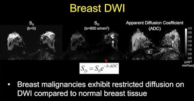 Malignancies present as bright spots on diffusion-weighted imaging due to showing restricted diffusion. Researchers say this imaging method could serve as an alternative to dynamic contrast-enhanced MRI, though more studies and standardization are needed. Image courtesy of Dr. Savannah Partridge.