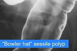 2021 12 02 00 02 0316 2021 12 02 Bowler Hat Polyp 20211202005147