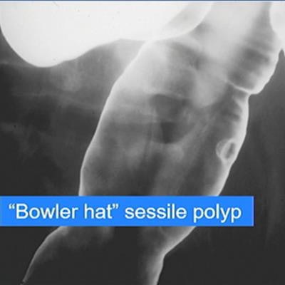 2021 12 02 00 02 0316 2021 12 02 Bowler Hat Polyp 20211202005147