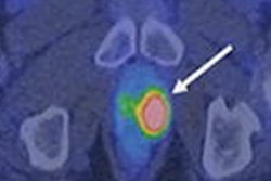 2021 12 02 00 05 2347 2021 12 02 Pylarify Prostate Cancer 20211202002241