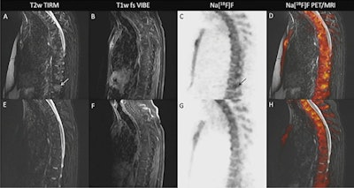 A 40-year-old patient with clinically active r-AxSpA and extensive bone edema on F-18 NaF-PET/MRI at baseline and at four-month follow-up. Image courtesy of Dr. Nils-Martin Bruckmann.