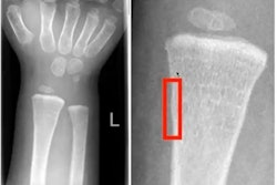 2021 12 03 23 03 6687 2021 12 06 Buckle Fracture 400