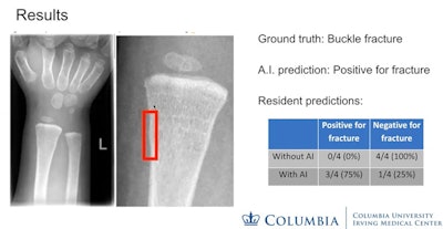 2021 12 03 23 40 2558 2021 12 06 Buckle Fracture