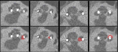 Midmodiolar ultrahigh-spatial-resolution CT scans with corresponding annotations indicating new bone formation (NBF) in red. Note the varying appearance of NBF, ranging from (A) slightly increased attenuation, resembling that of the modiolus, to (D) frank ossification with an attenuation similar to that of the otic capsule surrounding a translocated contact in the scala vestibuli. An intermediate form of NBF appearance is shown in B and C. Moreover, in B, the ossification between the perimodiolar positioned electrode contact and the medial cochlear wall is difficult to discern, resulting in interrater disagreement. Images and caption courtesy of the RSNA.