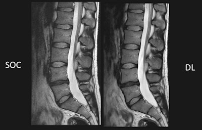 Comparison of standard of care (SOC) against deep learning-based (DL) reconstruction at 60% shorter scan time. Images courtesy of Dr. Lawrence Tanenbaum.