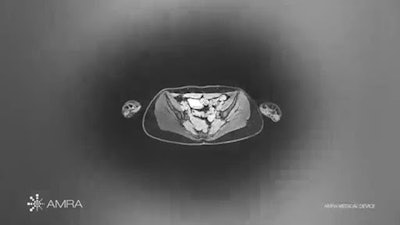 AMRA's MAsS Scan software provides muscle assessment on MRI exams. Image courtesy of AMRA Medical.