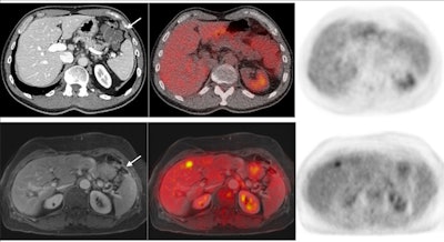 A case of peritoneal thickening not seen on CT and also showing no FDG avidity. Enhancement of pulse-contrast MRI sequences detected peritoneal carcinomatosis, which was later confirmed in surgery. Image courtesy of Dr. Felipe Furtado.