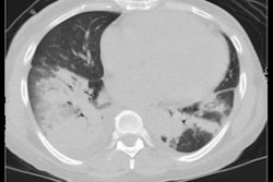 2021 12 09 23 06 2870 2021 12 10 Chest Ct Covid Breakthru Figure1 400