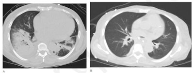 (A) Axial chest CT on lung windows of a patient at presentation demonstrates bilateral right greater than left lower lobe consolidations with surrounding ground-glass opacities. (B) Follow-up image two weeks later demonstrates substantial improvement in bilateral lower lobe consolidations with minimal residual opacities and tiny effusions. Image and caption courtesy of the RSNA.
