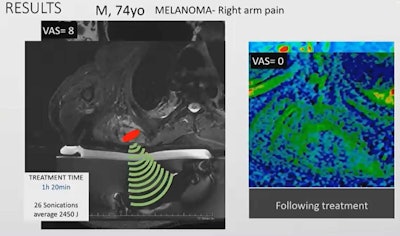 MRI-guided focused ultrasound can be an alternative method for palliative treatment of cancer patients with bone metastases, researchers said. Here, a 74-year-old male patient with arm pain related to melanoma received such treatment and reported a visual analogue scale score of 0 for pain. Before treatment, the score was 8, indicating severe pain. Image courtesy of Dr. Giulia Alfieri.