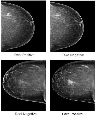 Mammogram images showing real cancer-positive (top left) and cancer-negative (bottom left) cases, with cancerous tissue indicated by white spot. A generative adversarial network program removed cancerous regions from the cancer-positive image, creating a fake negative image (top right) and inserted cancerous regions to the cancer-negative image, creating a fake positive (bottom right). Image courtesy of Qianwei Zhou, PhD, et al., Nature Communications.