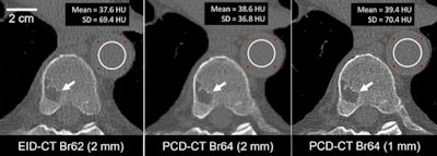 A 74-year-old male clinically indicated for a whole-body low-dose CT skeletal survey for multiple myeloma. Energy-integrating-detector CT (EID-CT) scan (axial image, left) and high-resolution photon-counting-detector CT (PCD-CT) scan (axial image, center and right) were acquired using the same radiation dose (4.2 mGy). PCD-CT images (center) using the same section thickness (2 mm) as EID-CT images (left) showed 47% lower noise (69.4 HU vs. 36.8 HU). Use of thinner (1 mm) section thickness (right) and 1024 x 1024 matrix resulted in image noise comparable to EID-CT and improved the delineation of a vertebral lesion (arrow). Display window/level = 1500/150 HU. Images and caption courtesy of the RSNA.