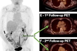 2021 12 15 01 22 4554 2021 12 15 Fdg Uptake Melanoma 20211215011043