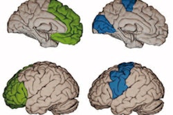 2021 12 18 00 19 0775 2021 12 20 Tau Pet Brain Stages 400